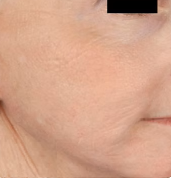After photo of microneedling
