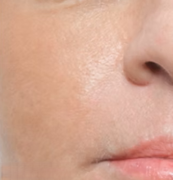 After photo of microneedling