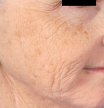 Before photo of microneedling