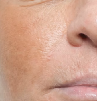 Before photo of microneedling