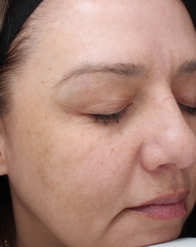 After photo of a VI Peel