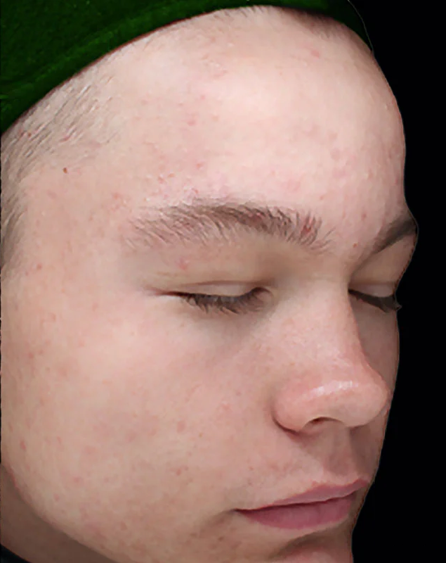 After photo of a VI Peel