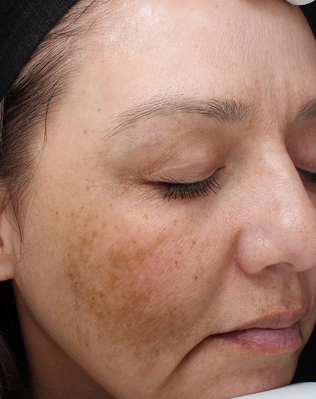 Before photo of a VI Peel
