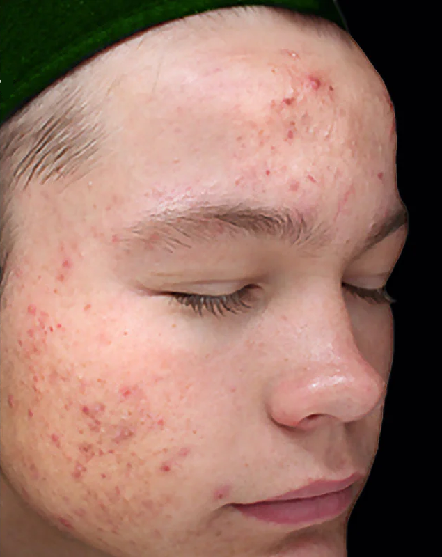 Before photo of a VI Peel